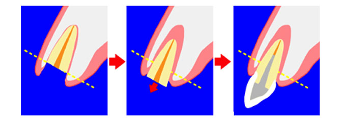 エクストリュージョン