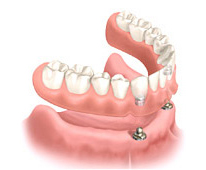 オーバーデンチャー(ボールタイプ)