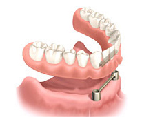 オーバーデンチャー(バータイプ)