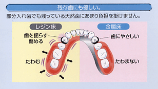 残存歯にも優しい