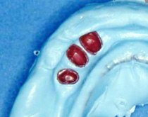 シリコン印象材の利用