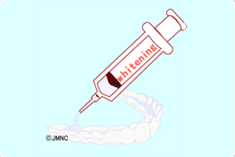 自宅でホワイトニング