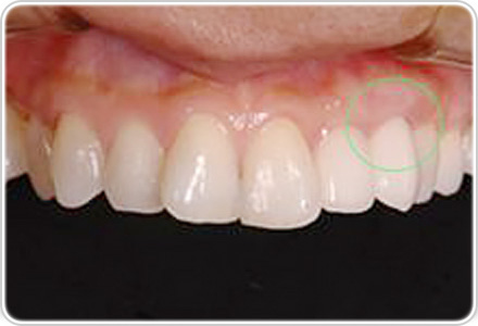 審美性を回復させる治療