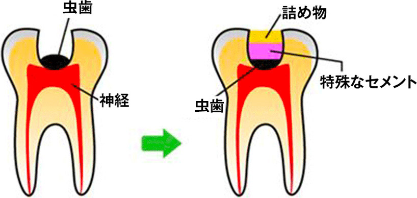 エクストリュージョン法